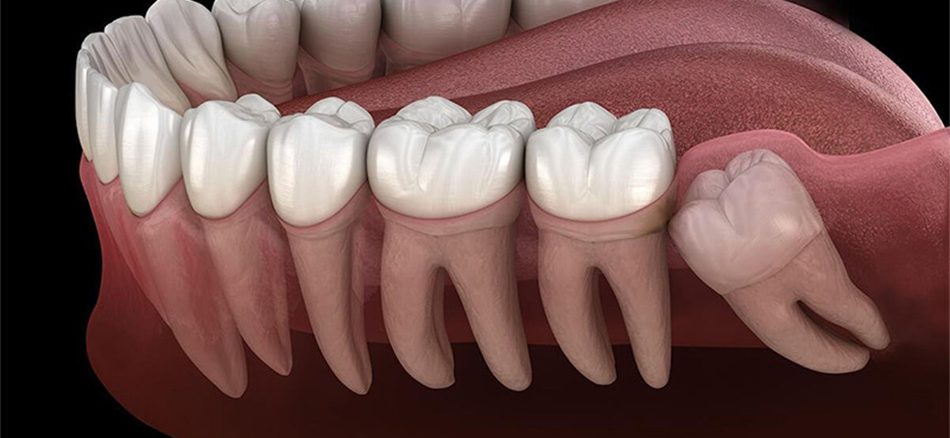 خارج کردن دندان نهفته