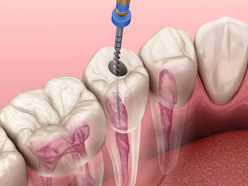 جراحی ریشه دندان