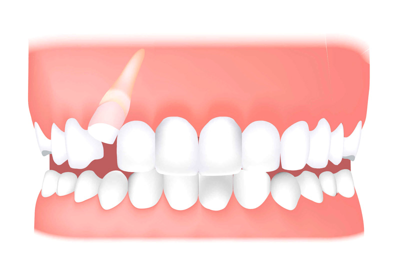 خارج کردن دندان نهفته