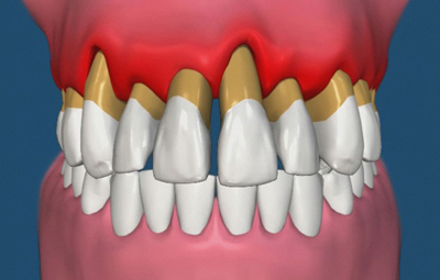 جراحی لثه در کرج