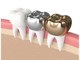 روکش دندان در کرج