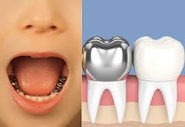 روکش دندان در کرج