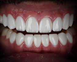 ونیر کامپوزیت دندان در کرج