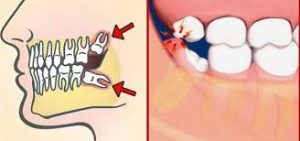 کشیدن دندان عقل در کرج