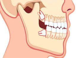 کشیدن دندان عقل در کرج