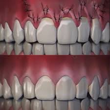 جراحی لثه در کرج