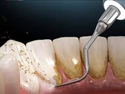 جرم گیری دندان در کرج