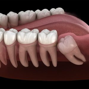 جراحی دندان عقل نهفته