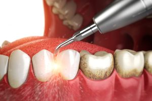 جرم گیری دندان در کرج