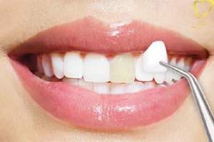 ونیر کامپوزیت دندان در کرج