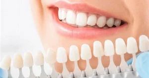 ونیر کامپوزیت دندان در کرج