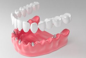 ساخت پروتز دندان در کرج