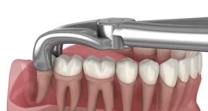 کشیدن دندان در کرج