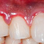 650x350_gum_disease_symptoms_and_treatments_features
