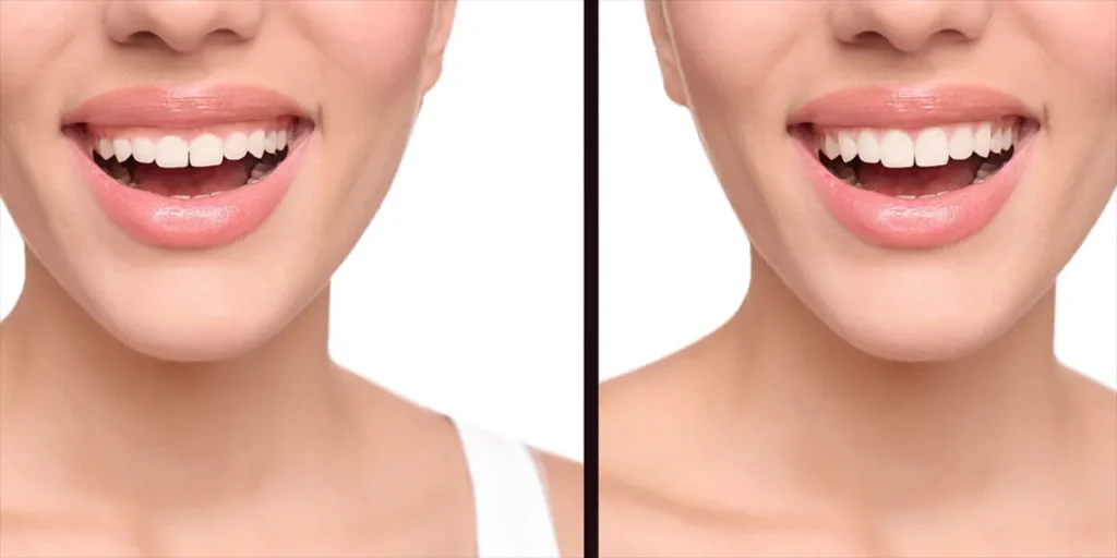 جراحی زیبایی لثه