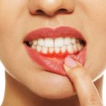 cause-the-Abscess-in-your-Tooth