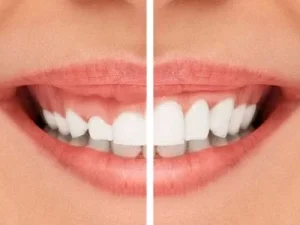 جراحی زیبایی لثه