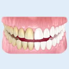 بلیچینگ دندان در کرج