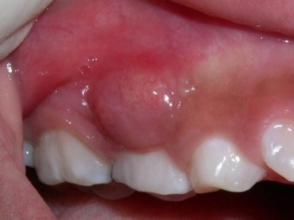 رفع عفونت لثه در کرج