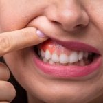 دلایل-ورم-لثه-چیست؟-درمان-و-پیشگیری