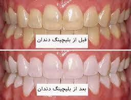 سفید کردن دندان در کرج
