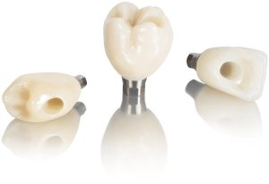 روکش دندان ایمپلنت