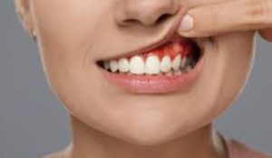 درمان تحلیل لثه در آزادگان کرج