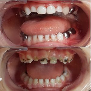 ترمیم دندان شیری کودک