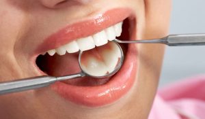 کامپوزیت دندان آزادگان