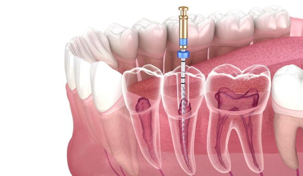 عصب کشی مجدد دندان (ری اندو) کرج