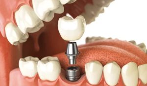 پروتز ثابت و متحرک در آزادگان کرج