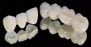 روکش دندان ایملپنت