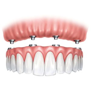 پروتز زیبایی دندان در کرج