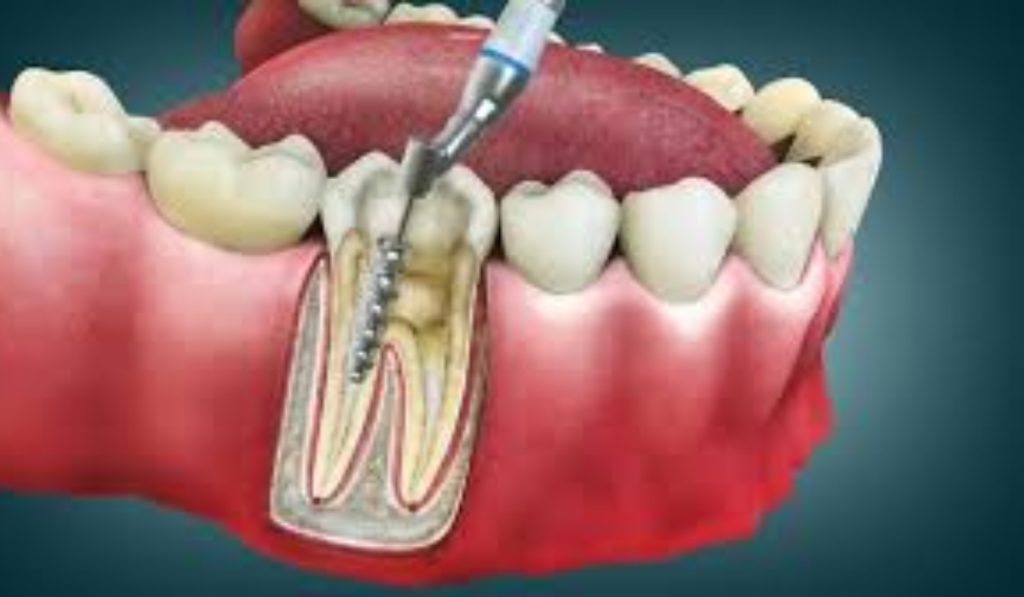 درمان ریشه تخصصی در آزادگان کرج