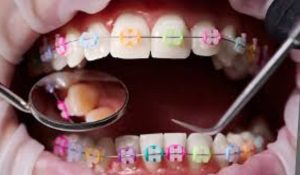 هزینه ارتودنسی در آزادگان کرج