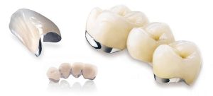 روکش دندان ایمپلنت