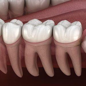 خارج کردن دندان نهفته