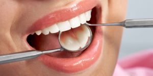 کامپوزیت دندان آزادگان