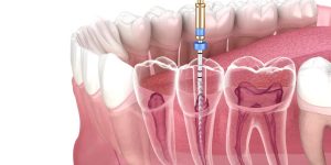 عصب کشی مجدد دندان (ری اندو) کرج