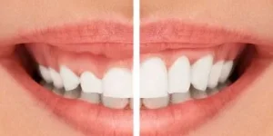 جراحی زیبایی لثه