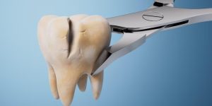 ترمیم دندان شکسته