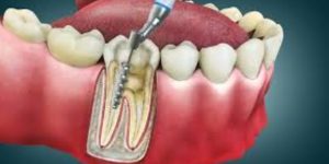 درمان ریشه تخصصی در آزادگان کرج