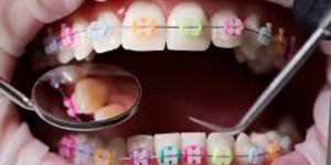 هزینه ارتودنسی در آزادگان کرج