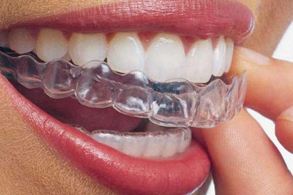 ارتودنسی نامرئی در کرج